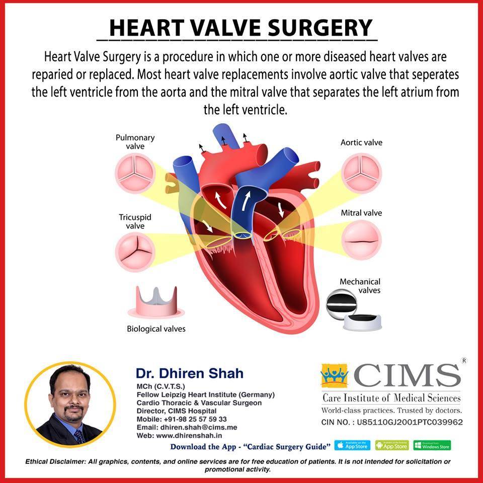 Heart Valve Surgery