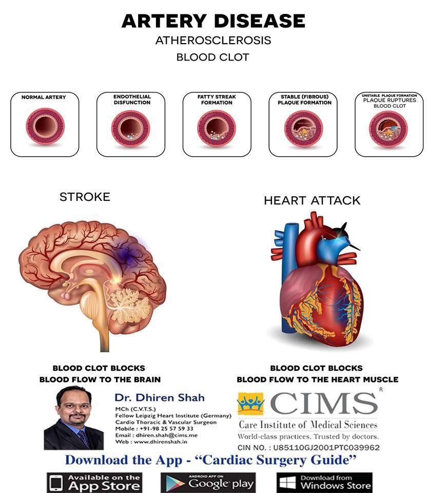 Artery Disease