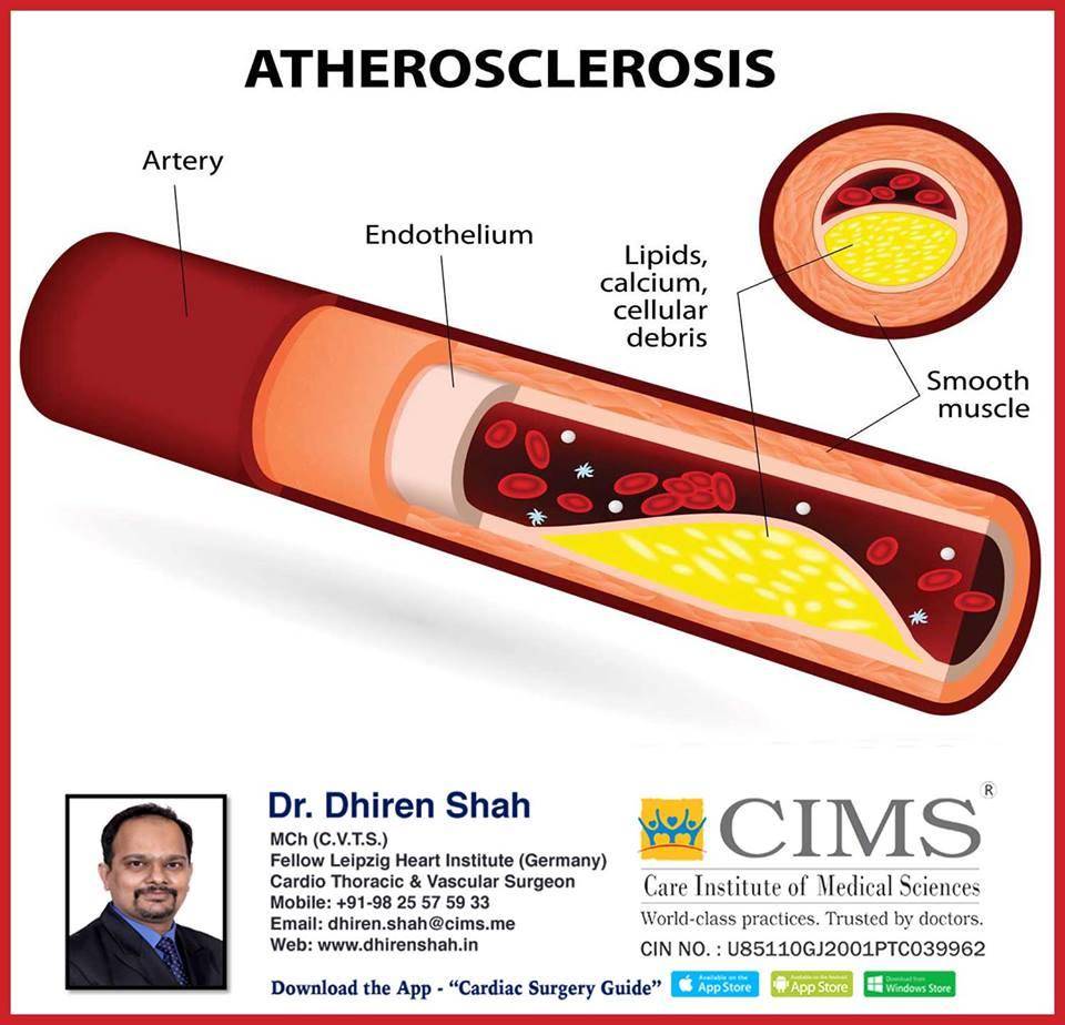 Atherosclerosis