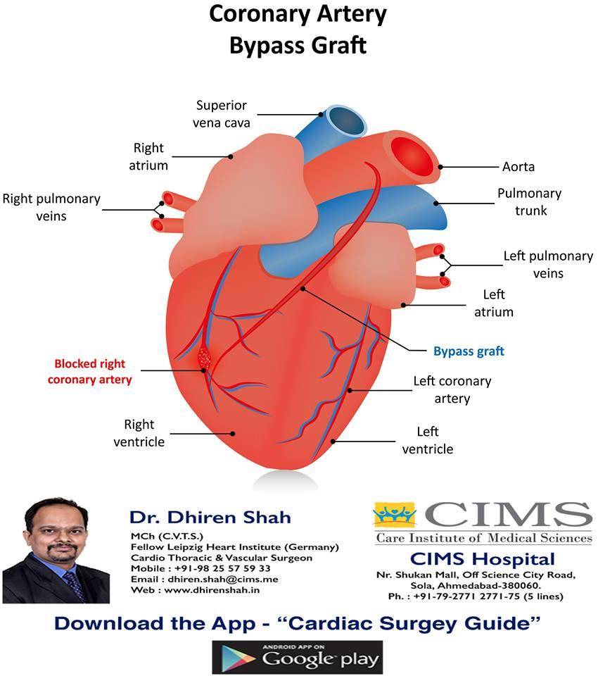 Coronary Artery Bypass Graft