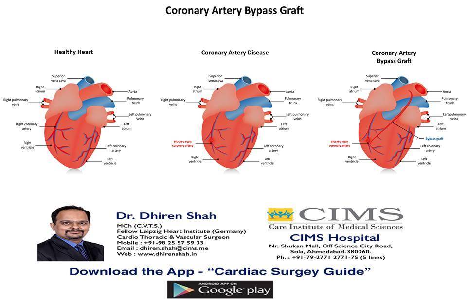 Coronary Artery bypass Graft