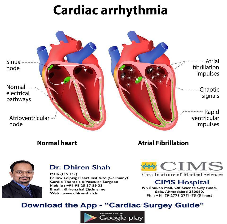 cardiac arrhythmia