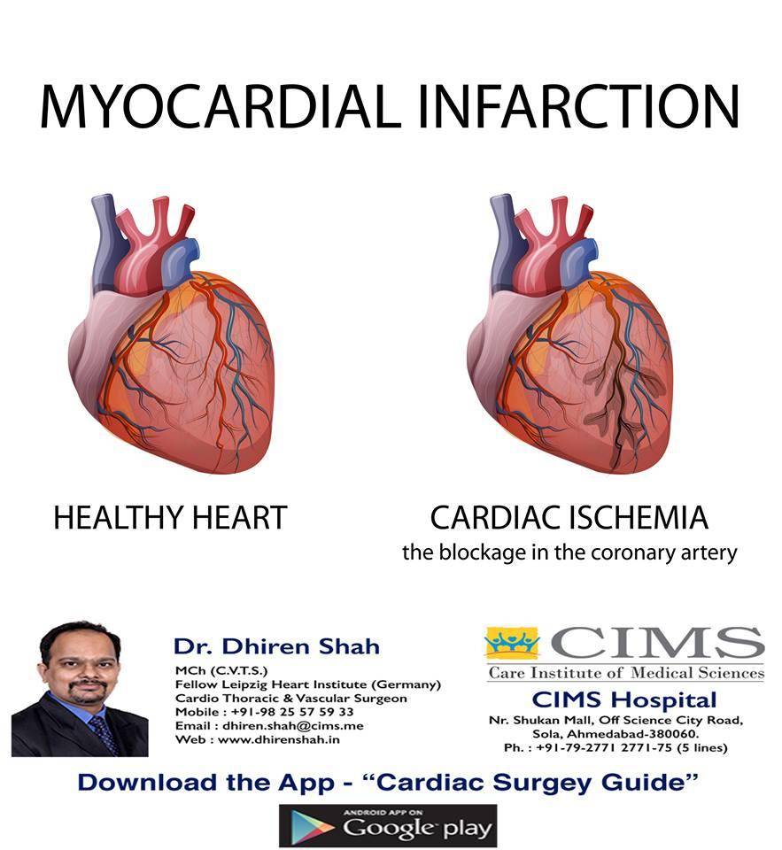 myocardial infarction