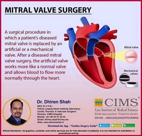 Mitral Valve Surgery