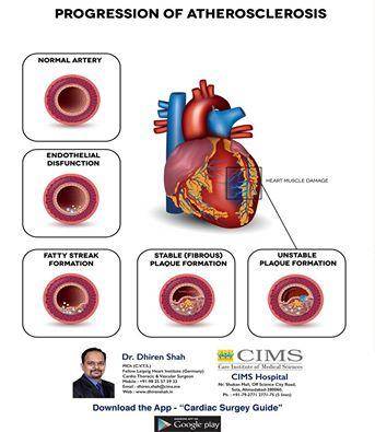 progression of atherosclerosis