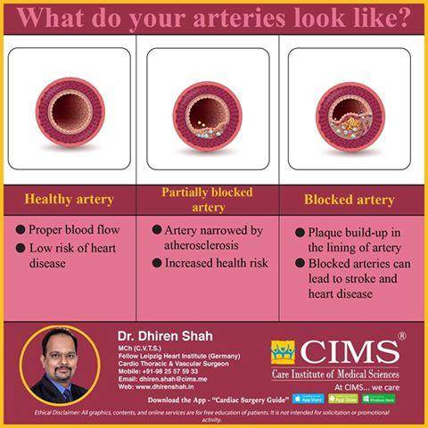 What do your arteries loook like?