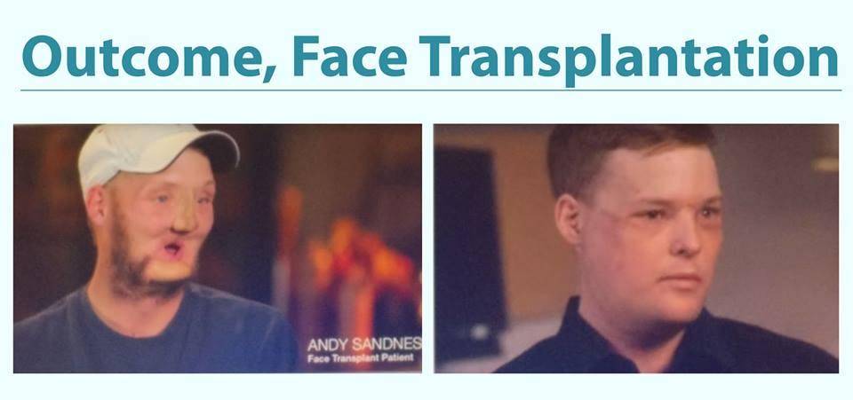 See the miracle of medical science and technology. This is a photo of a patient after face transplant. Everyone needs to have faith in medical science and doctors.