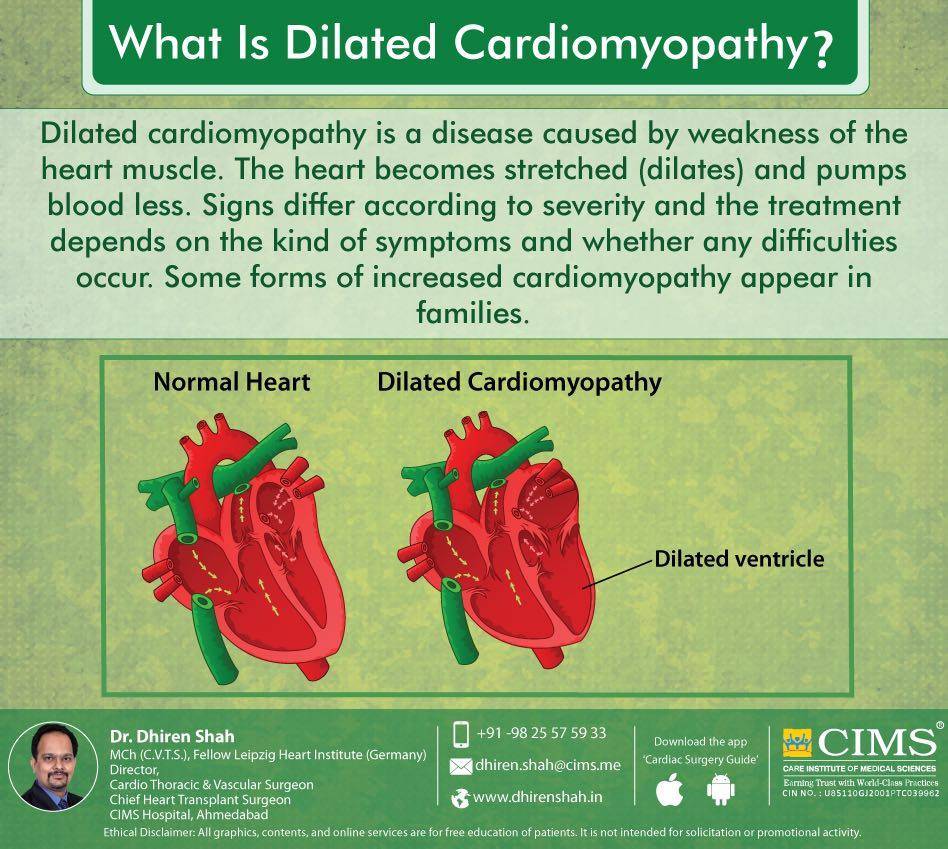 What is dilated cardiomyopathy?