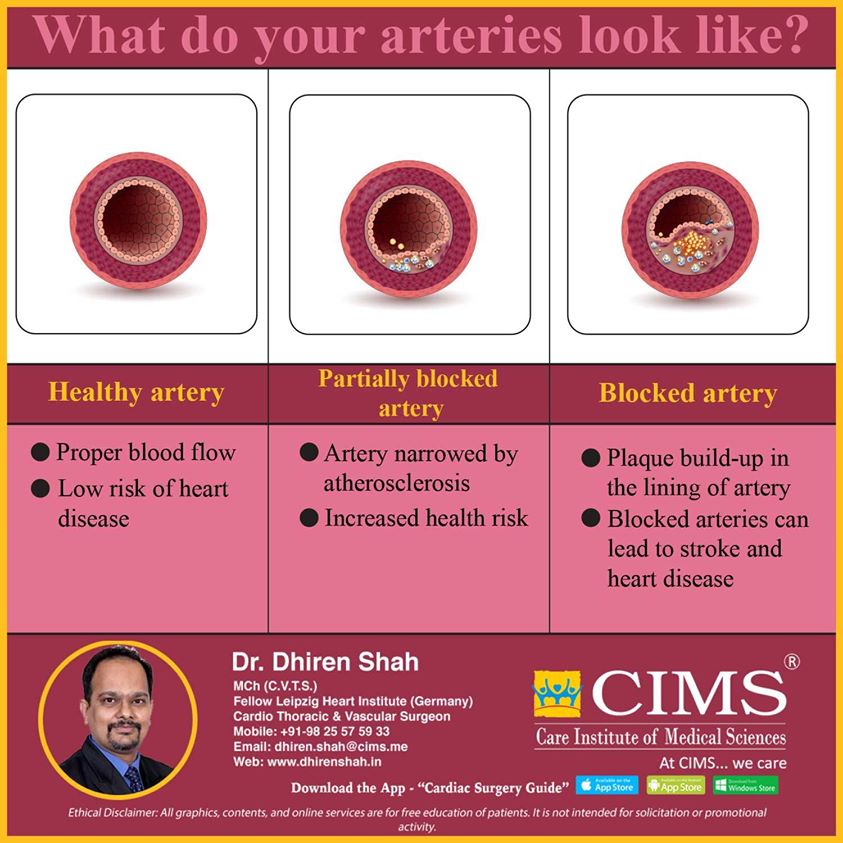 What do your arteries look like?