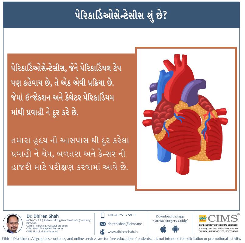 પેરિકાર્ડિઓસેન્ટેસીસ શું છે?