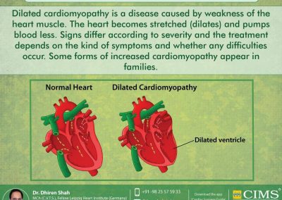 What is dilated cardiomyopathy?