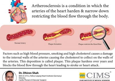 What is artherosclerosis?