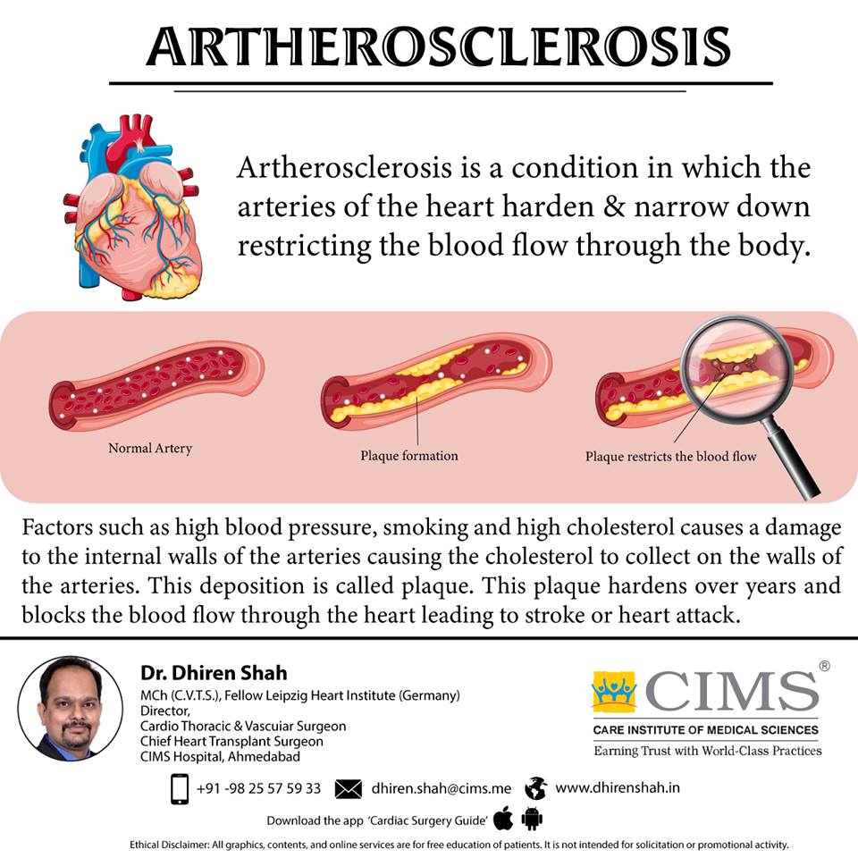 What is artherosclerosis?  