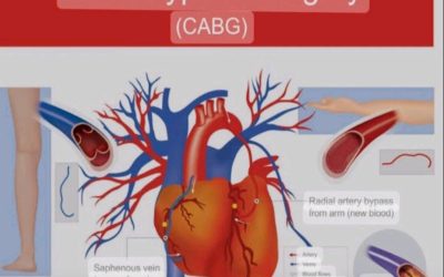 Factors to consider when deciding on CABG or Heart Bypass Surgery